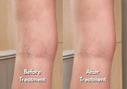Targeted Vein Appearance Care