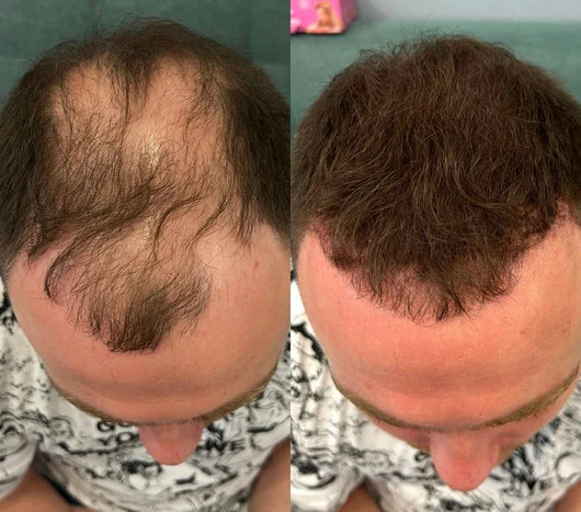 Miasaki Hair Density Filler