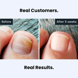 Miasaki Antifungal Treatment Pen