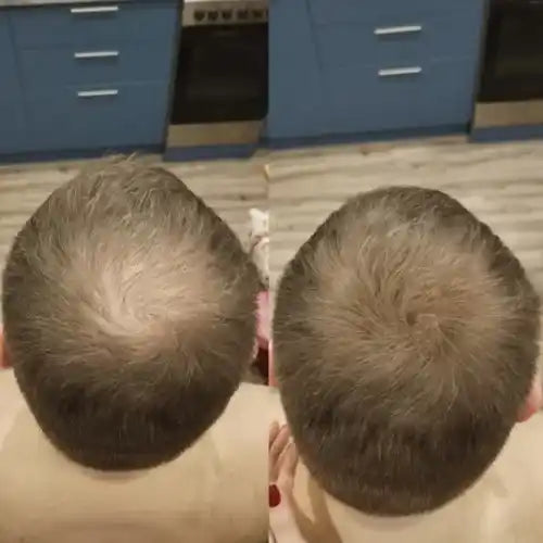Miasaki Hair Density Filler