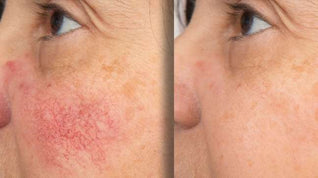 Miasaki Rosacea Corrector