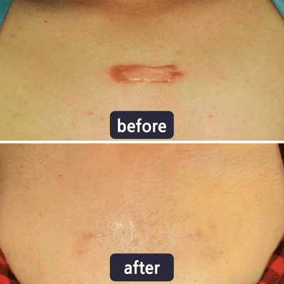 Miasaki Scar Removal Cream